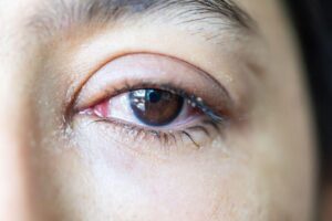 Watery Eyes