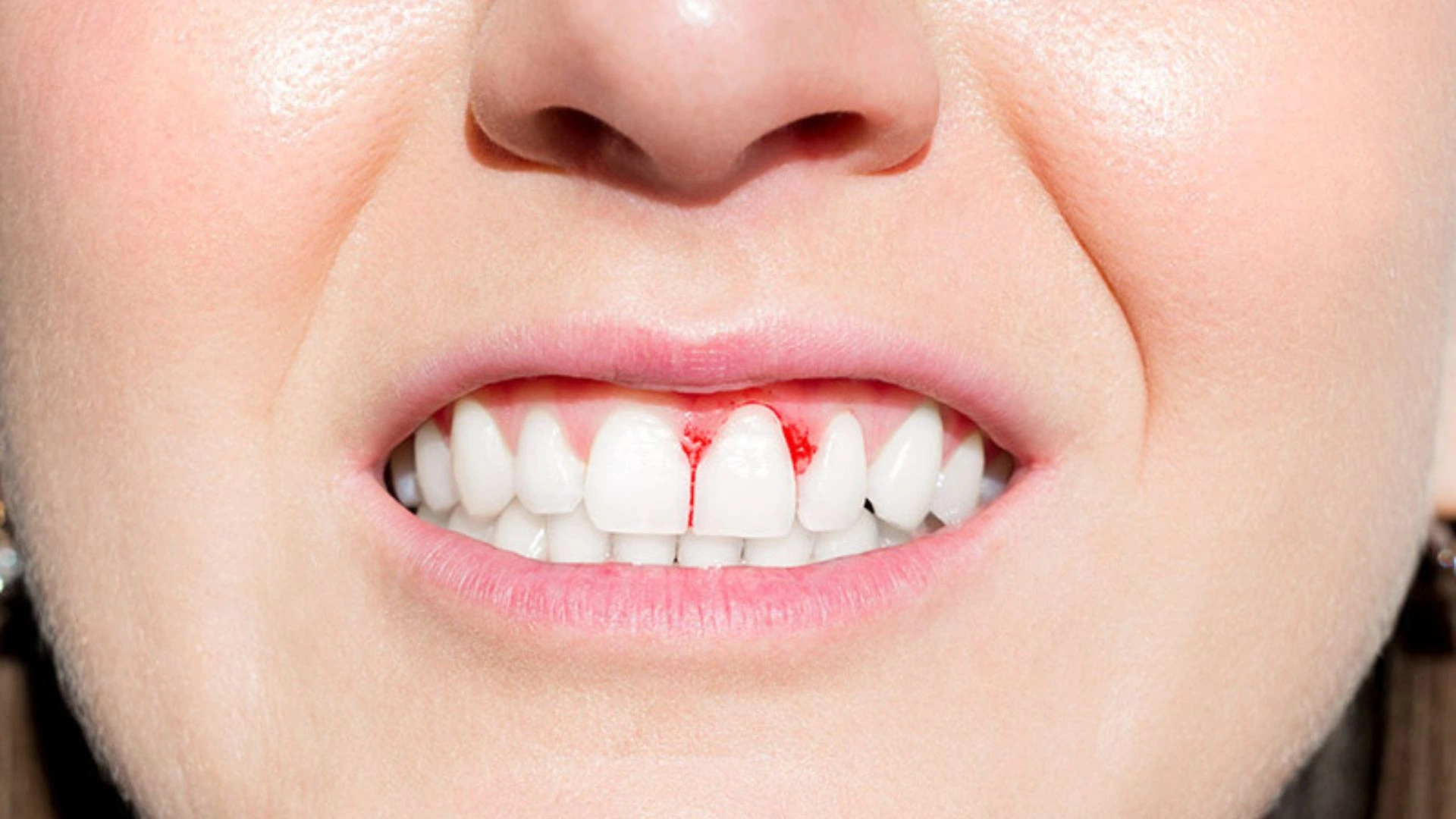 Bleeding Gums