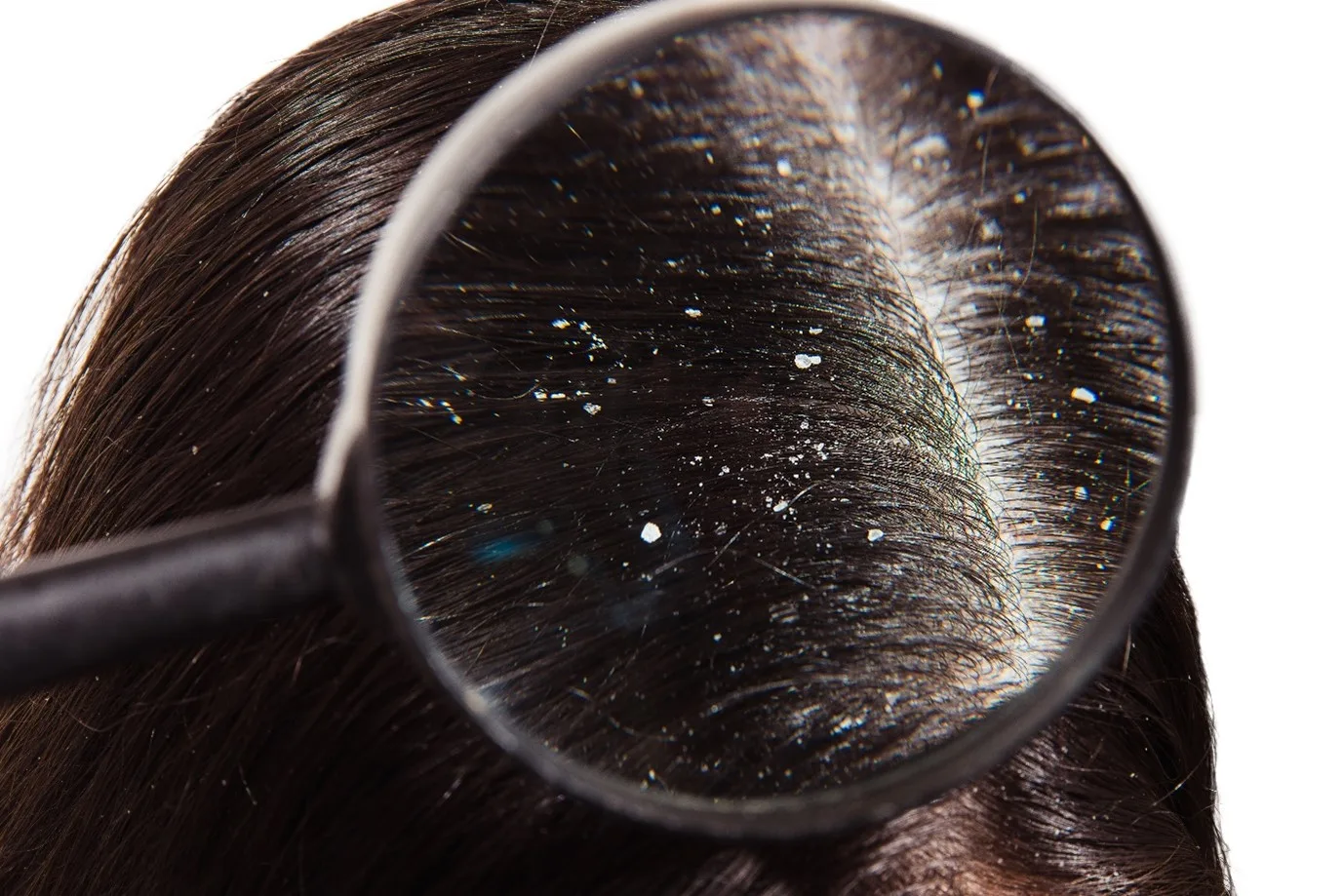 Dandruff