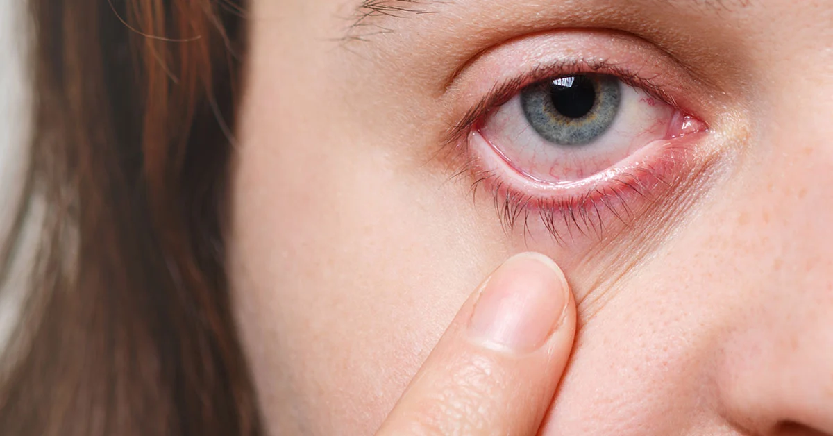 Dry eyes