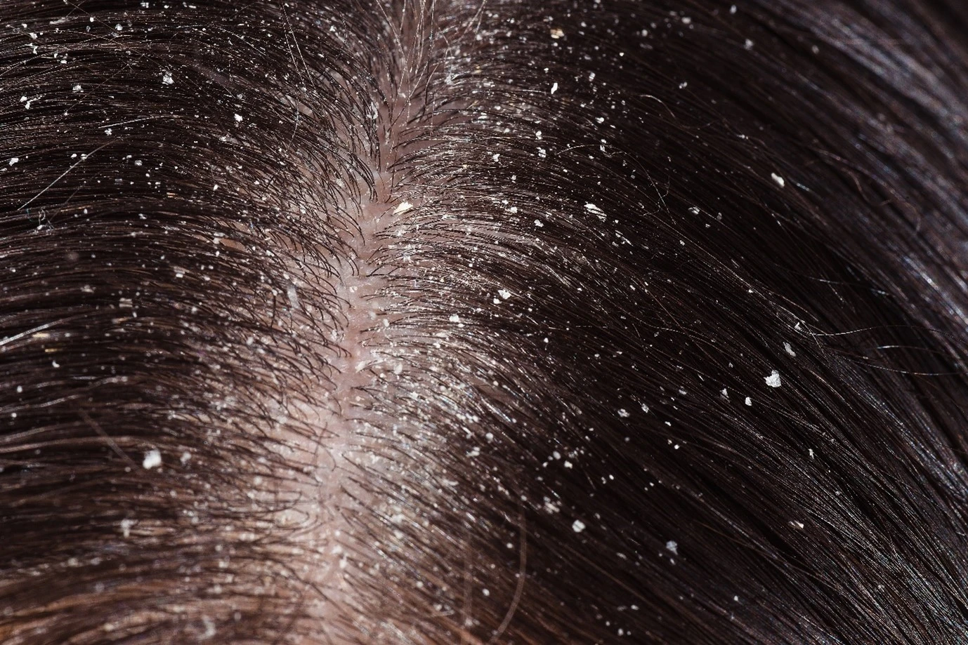 Dry scalp 