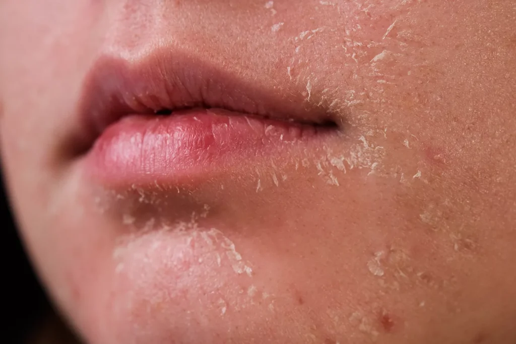 Dry skin