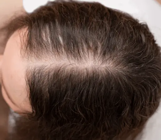 Hair Thinning 