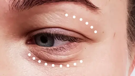 Heaviness near eyes 