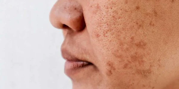 Pigmentation-Dark spots