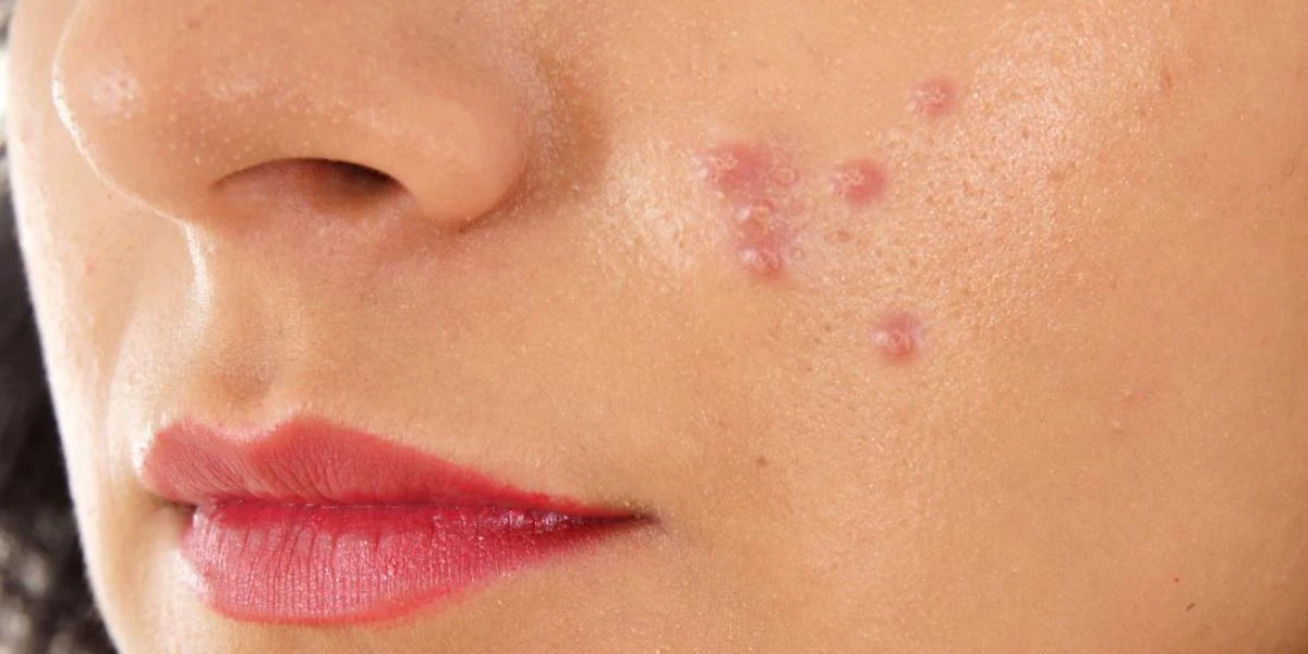 Pimples