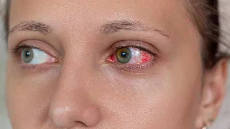 Redness and itching in eyes