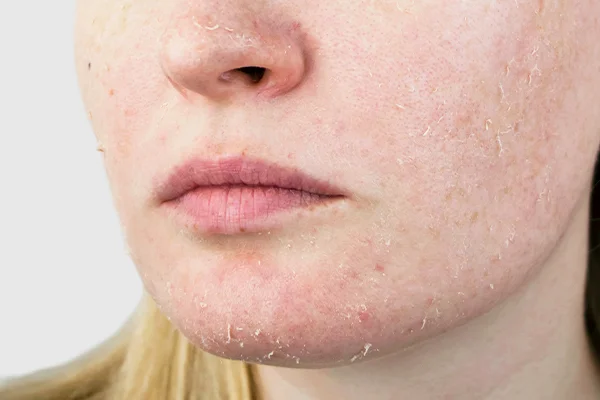 Rough skin
