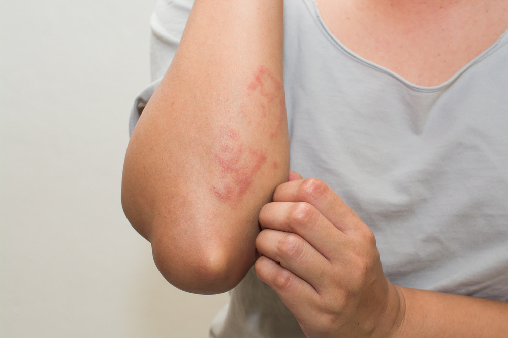 Skin rashes Itching 