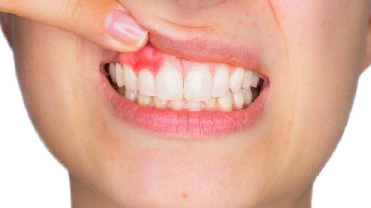 Swelling in gums