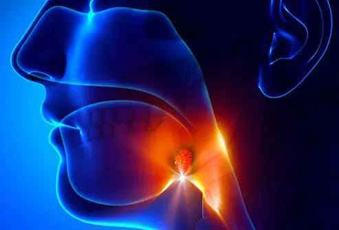 Tonsilitis 