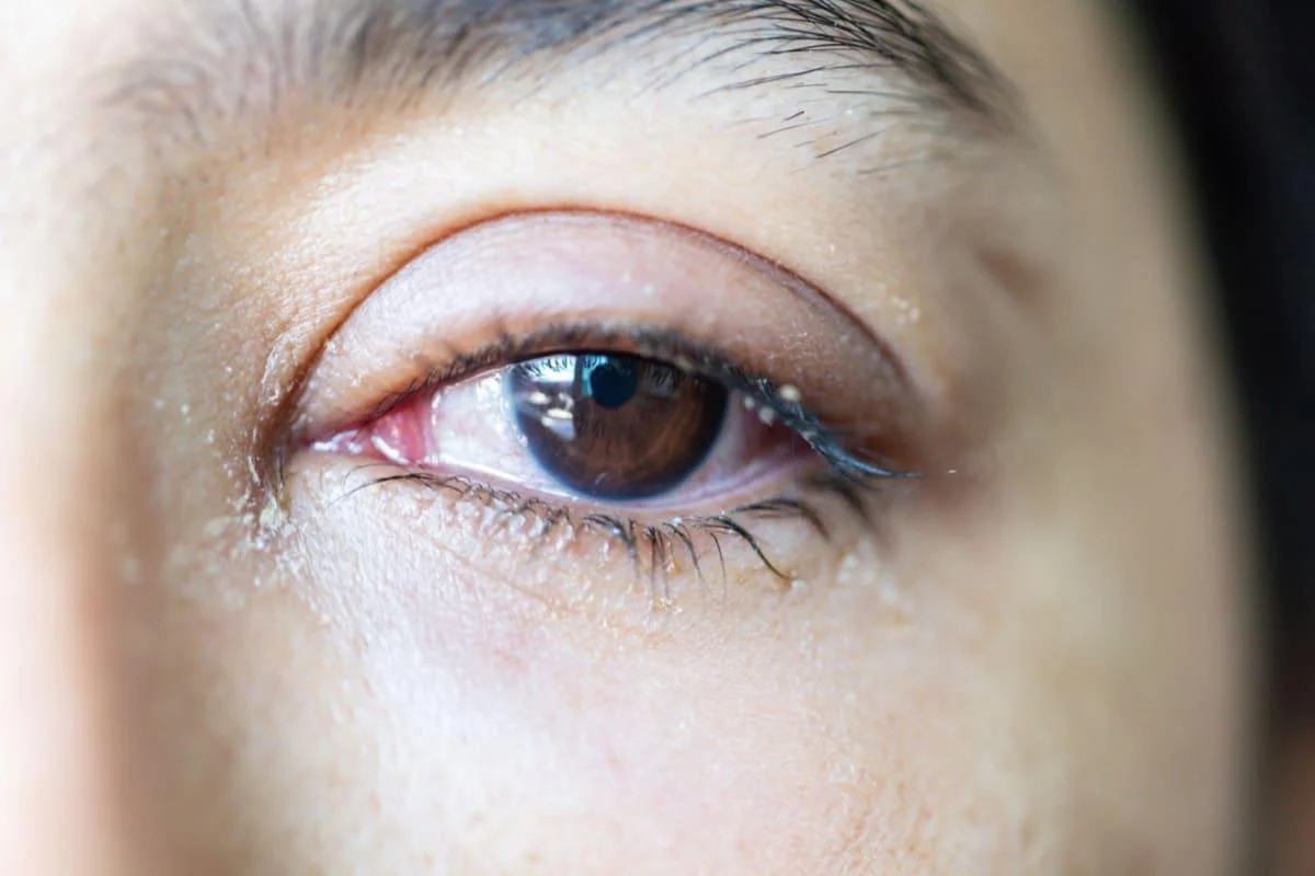 Watery eyes