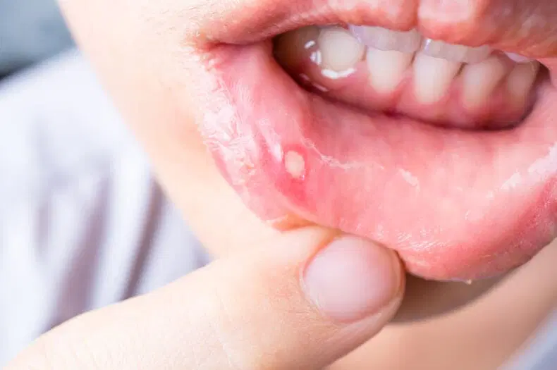 Mouth Ulcers 